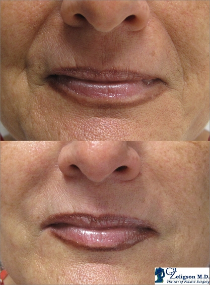 Dr. Gil Zeligson - Lips augmentaion & Wrinkles filling