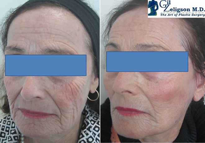 Dr. Gil Zeligson - Facelift