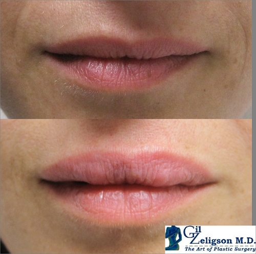 Dr. Gil Zeligson - Lips augmentaion & Wrinkles filling