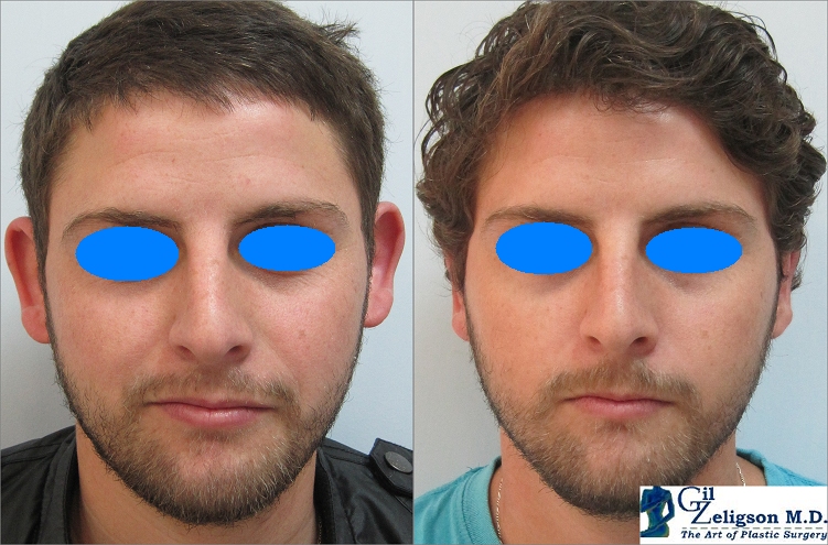 Dr. Gil Zeligson - Otoplasty