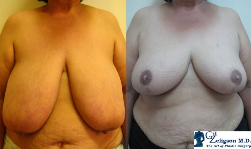 Dr. Gil Zeligson - Breast Reduction