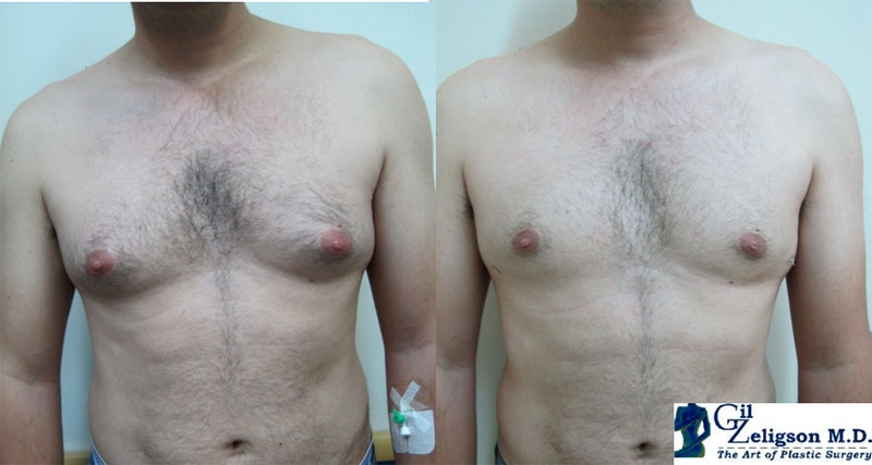 Dr. Gil Zeligson - Gynecomasty