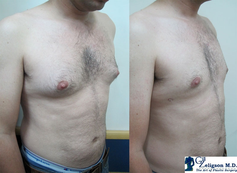 Dr. Gil Zeligson - Gynecomasty