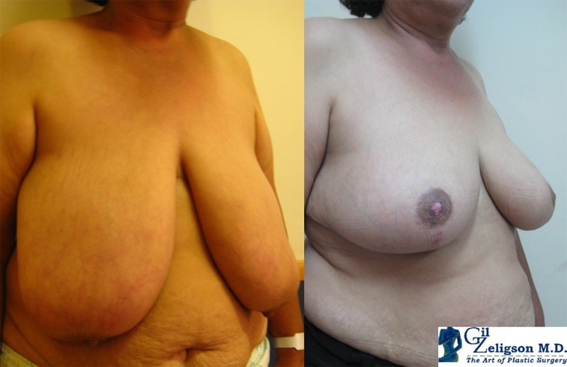 Dr. Gil Zeligson - Breast Reduction