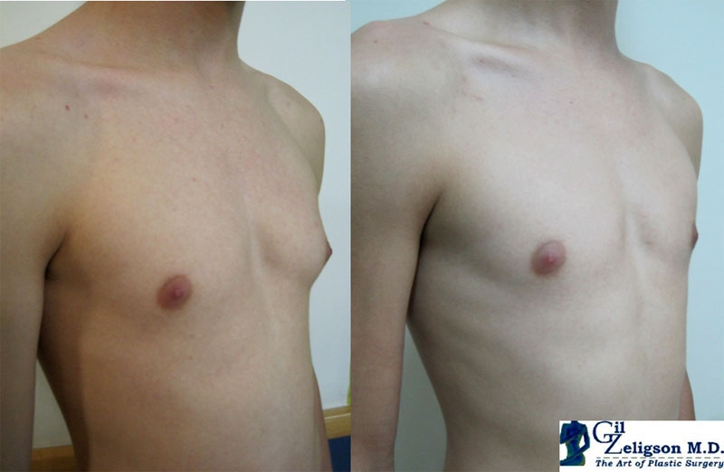 Dr. Gil Zeligson - Gynecomasty
