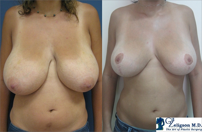 Dr. Gil Zeligson - Breast Reduction