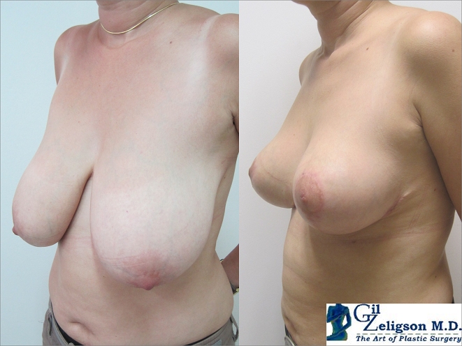 Dr. Gil Zeligson - Breast Reduction