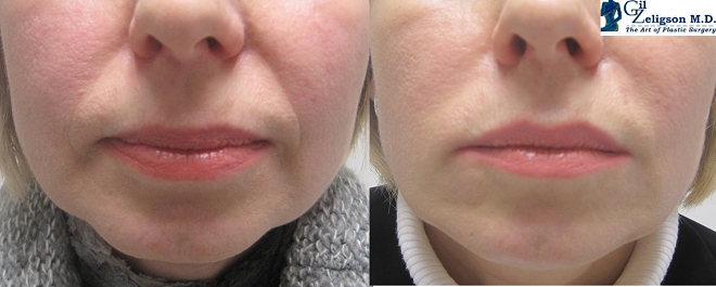 Dr. Gil Zeligson - Lips augmentaion & Wrinkles filling