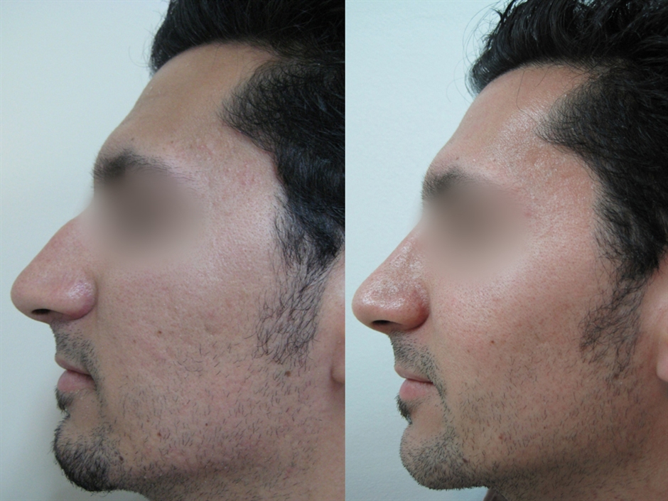 Dr. Gil Zeligson - Rhinoplasty