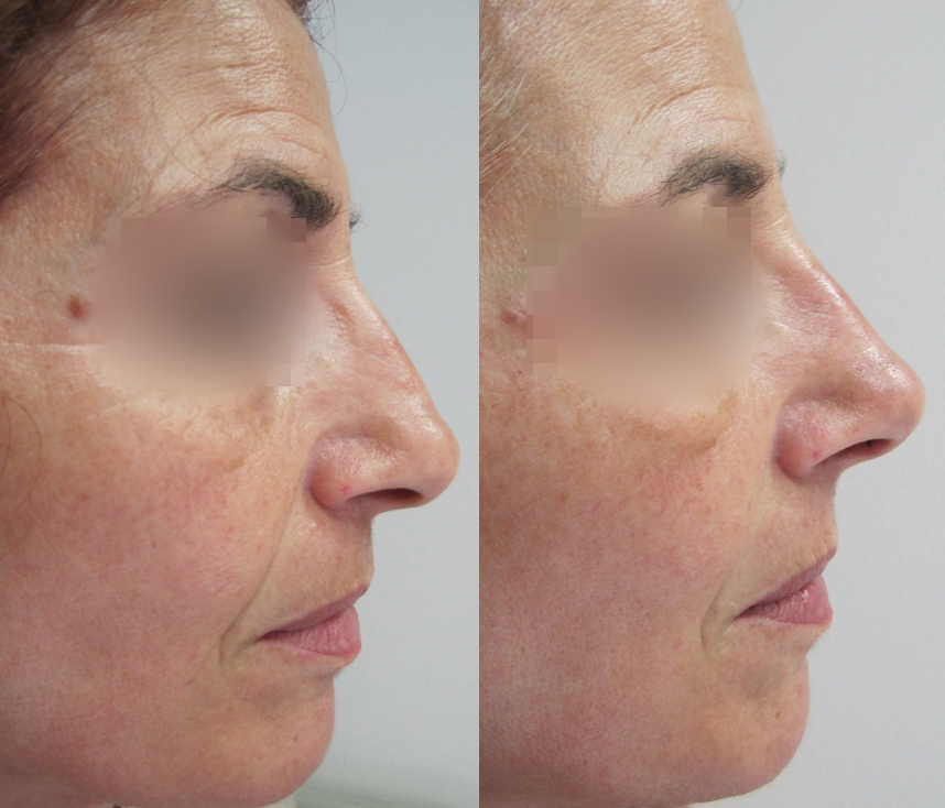 Dr. Gil Zeligson - Rhinoplasty