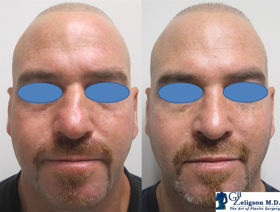 Dr. Gil Zeligson - Rhinoplasty
