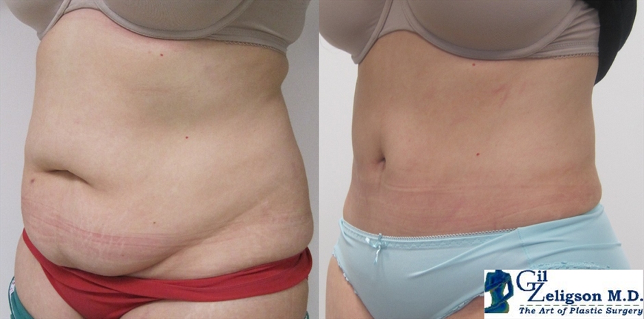 Dr. Gil Zeligson - Tummy Tuck Abdomino plasty