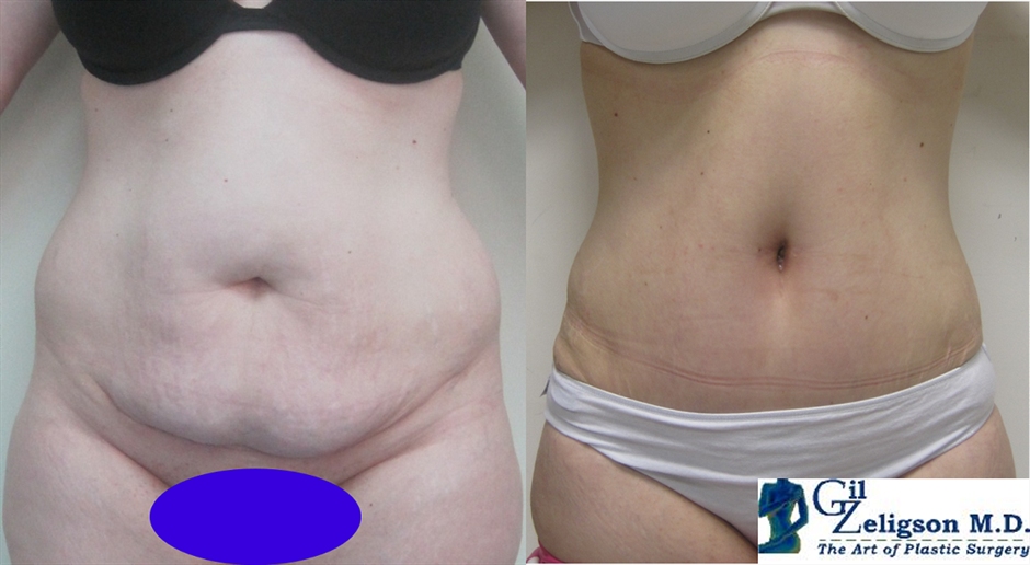 Dr. Gil Zeligson - Tummy Tuck Abdomino plasty