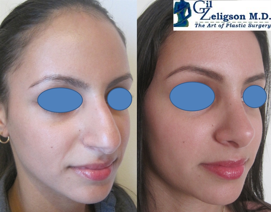 Dr. Gil Zeligson - Rhinoplasty