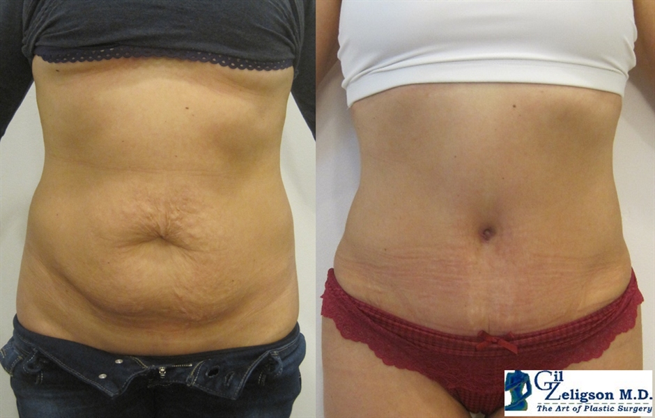 Dr. Gil Zeligson - Tummy Tuck Abdomino plasty