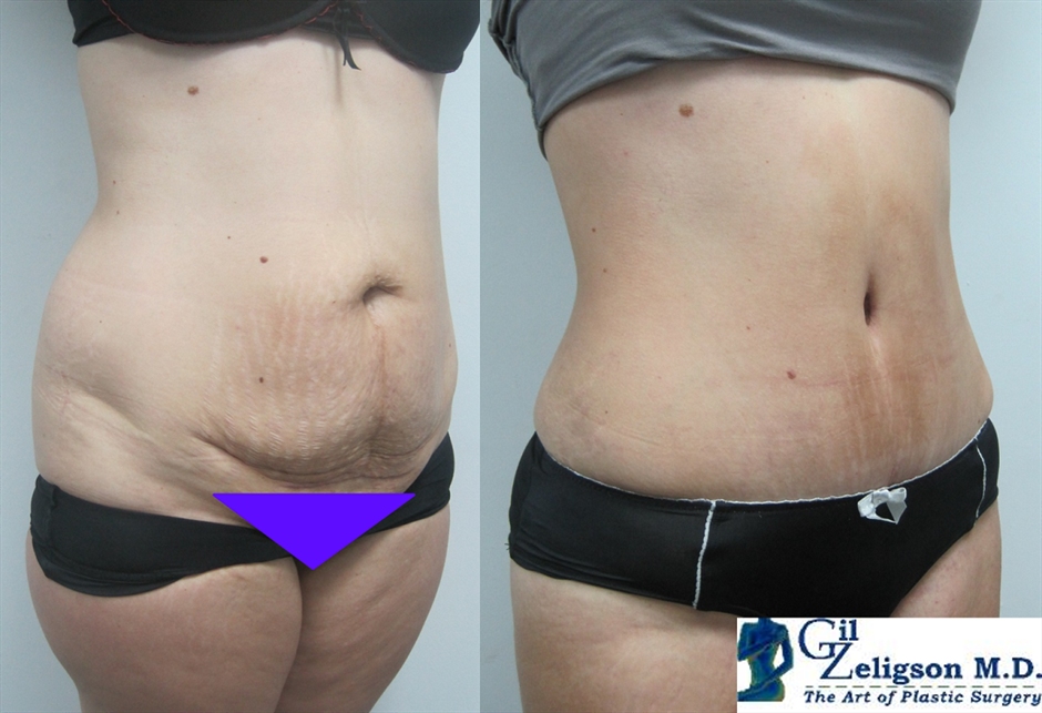 Dr. Gil Zeligson - Tummy Tuck Abdomino plasty