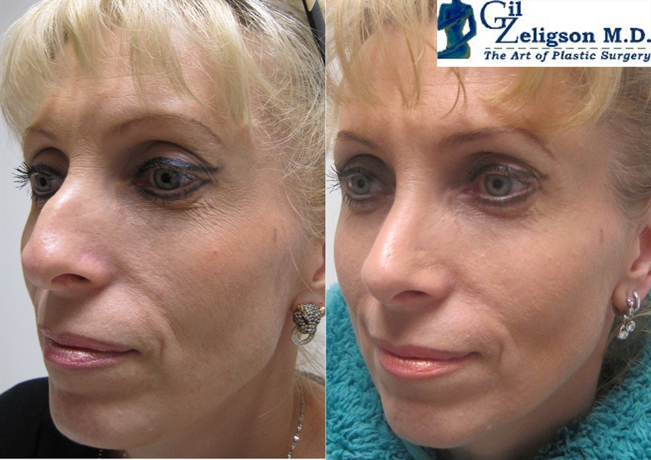 Rhinoplasty