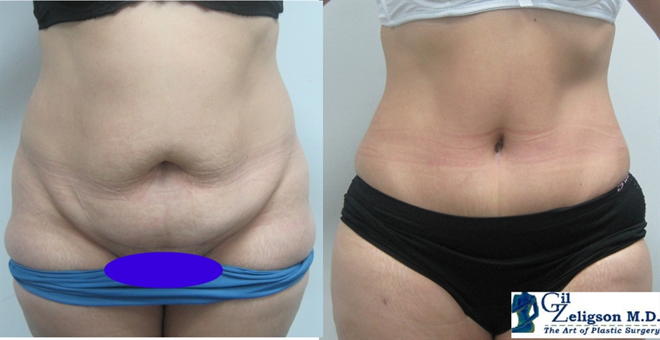 Dr. Gil Zeligson - Tummy Tuck Abdomino plasty