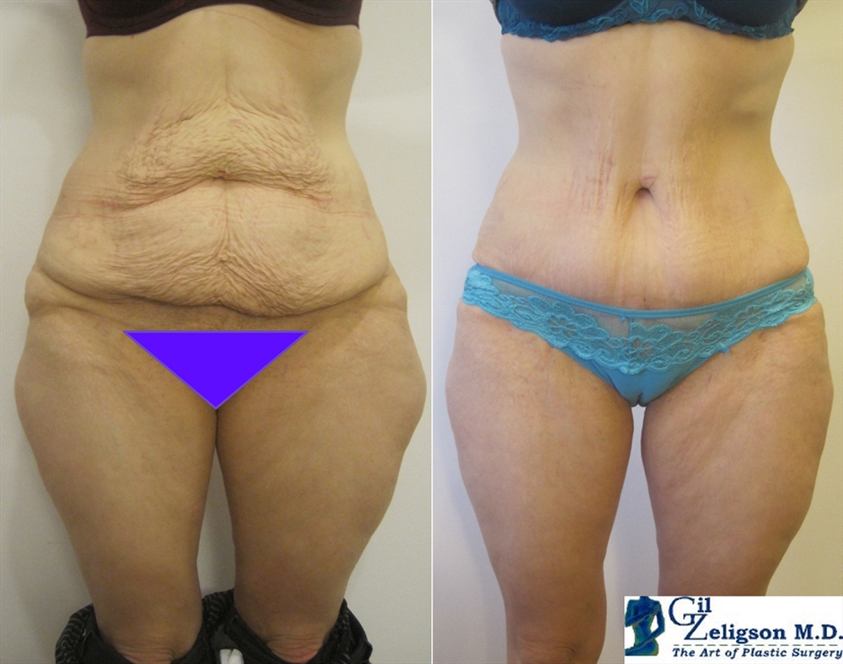Dr. Gil Zeligson - Tummy Tuck Abdomino plasty
