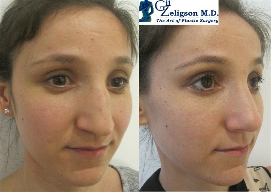 Dr. Gil Zeligson - Rhinoplasty