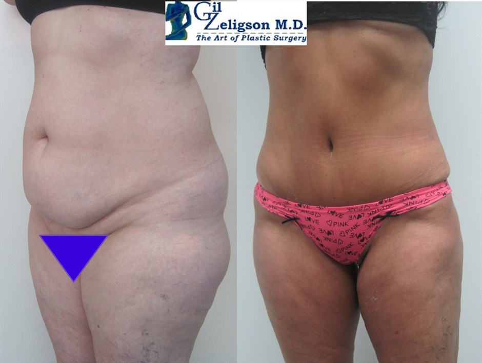 Dr. Gil Zeligson - Tummy Tuck Abdomino plasty