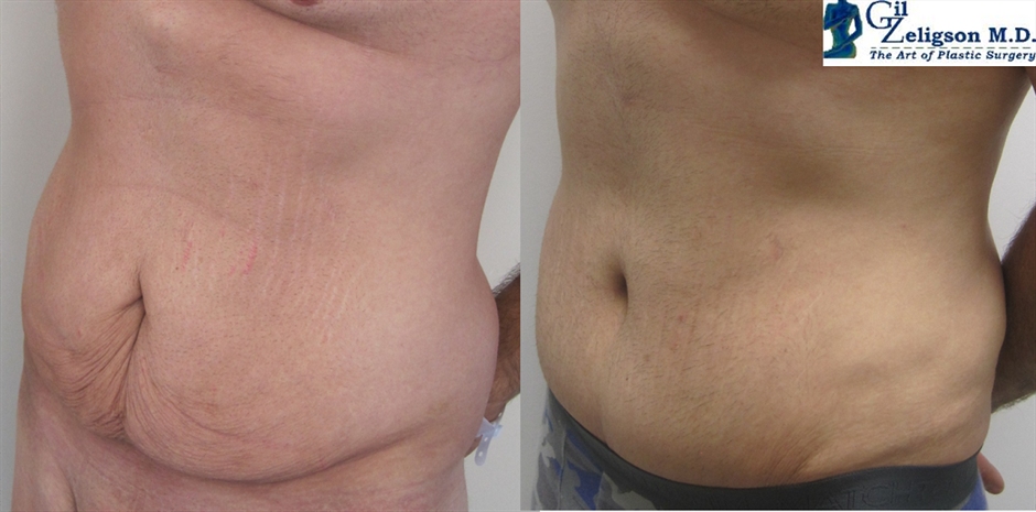Dr. Gil Zeligson - Tummy Tuck Abdomino plasty