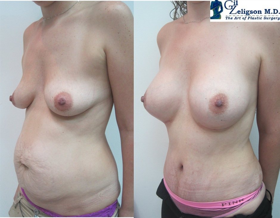 Dr. Gil Zeligson - Tummy Tuck Abdomino plasty