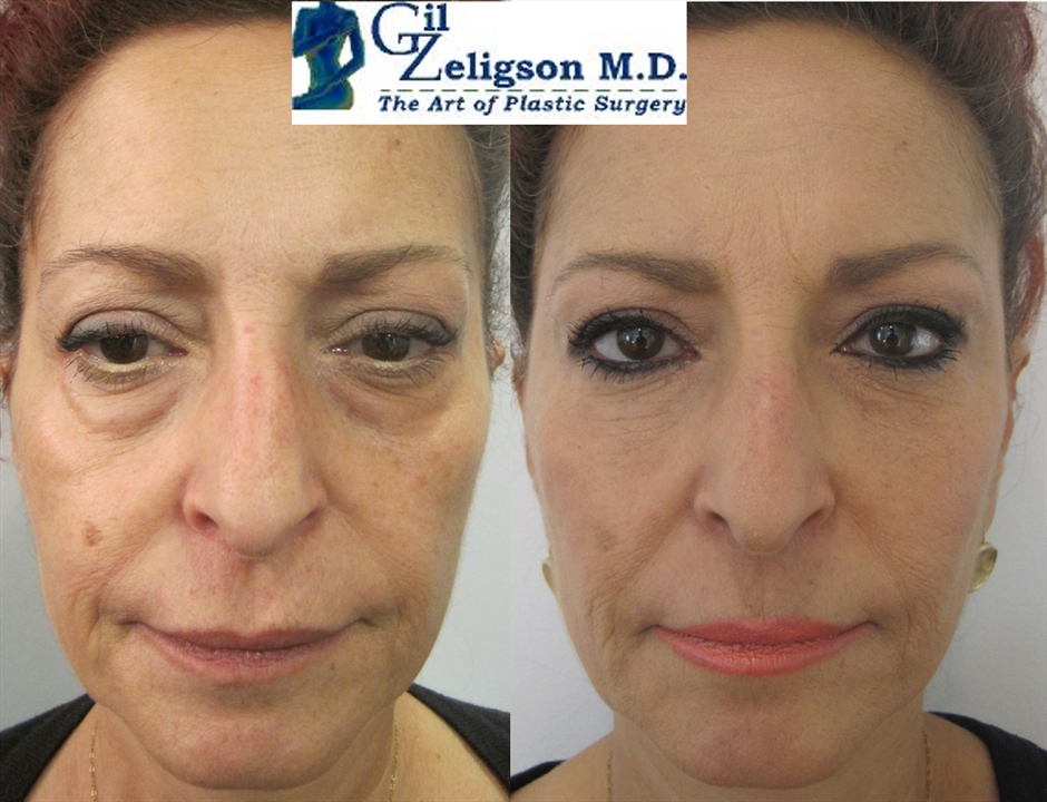 Dr. Gil Zeligson - Facial Sculpturing Hyaluronic acid
