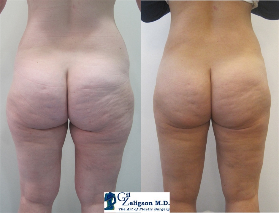 Dr. Gil Zeligson - Liposuction