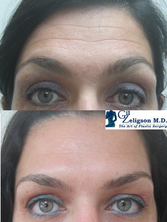 Dr. Gil Zeligson - Botox
