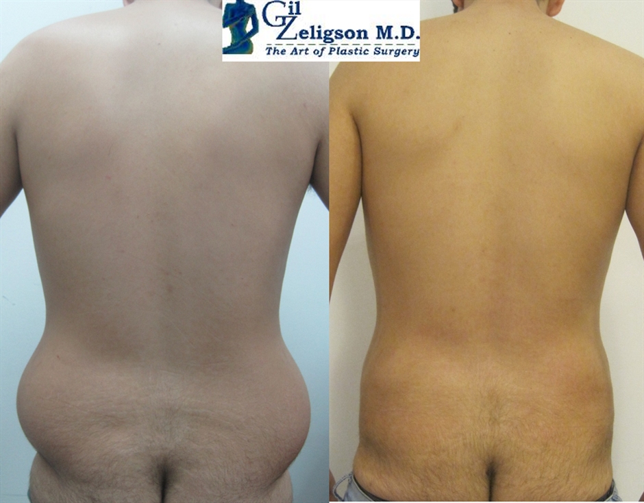 Dr. Gil Zeligson - Liposuction