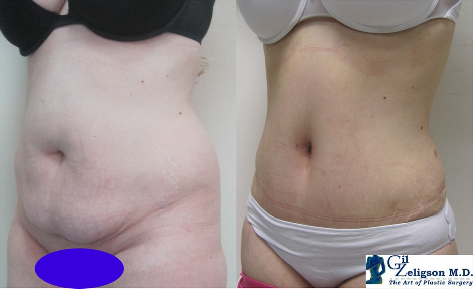 Dr. Gil Zeligson - Tummy Tuck Abdomino plasty