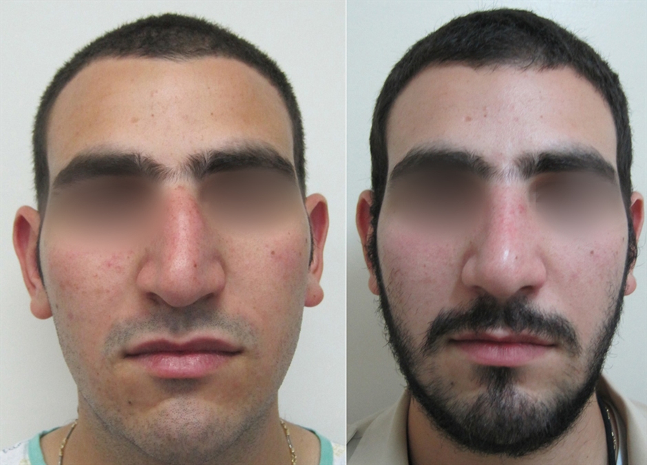 Dr. Gil Zeligson - Rhinoplasty