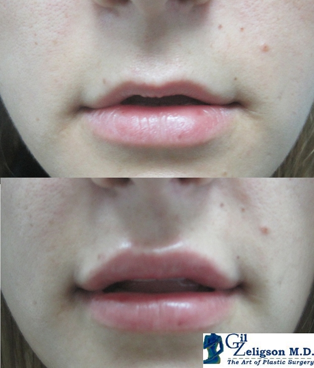 Dr. Gil Zeligson - Lips augmentaion & Wrinkles filling