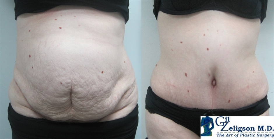 Dr. Gil Zeligson - Tummy Tuck Abdomino plasty