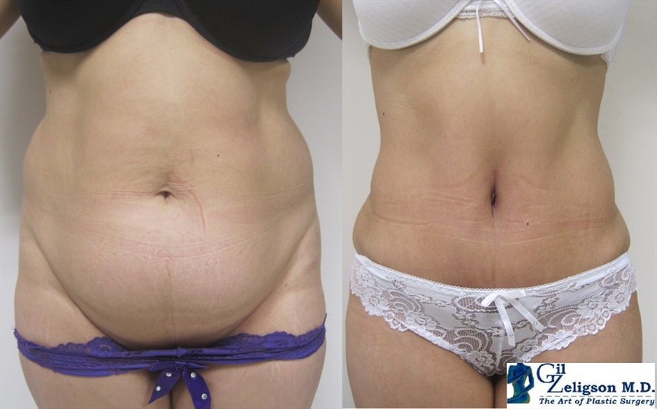Dr. Gil Zeligson - Tummy Tuck Abdomino plasty