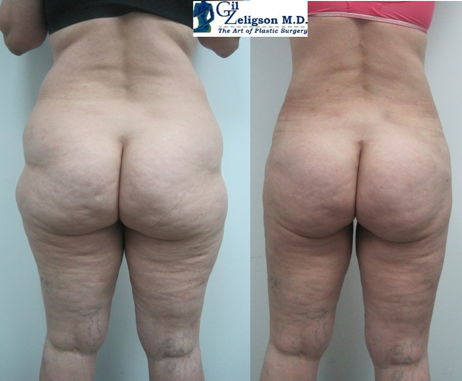 Dr. Gil Zeligson - Liposuction
