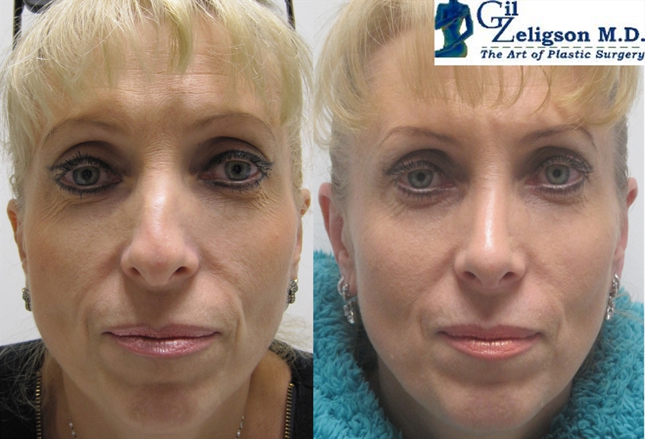 Dr. Gil Zeligson - Rhinoplasty