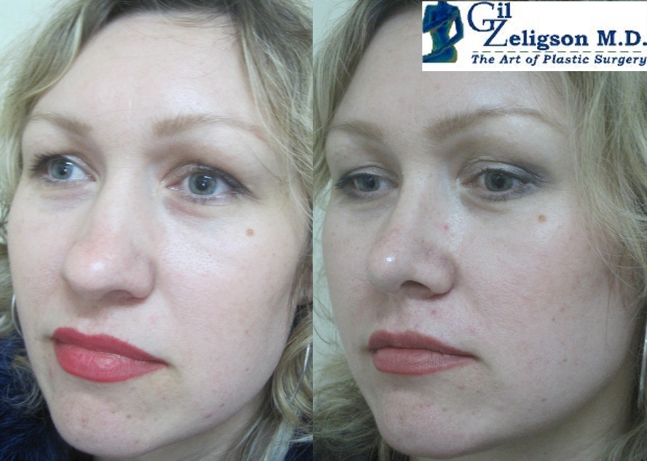 Dr. Gil Zeligson - Rhinoplasty