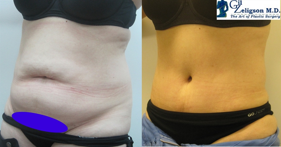 Dr. Gil Zeligson - Tummy Tuck Abdomino plasty