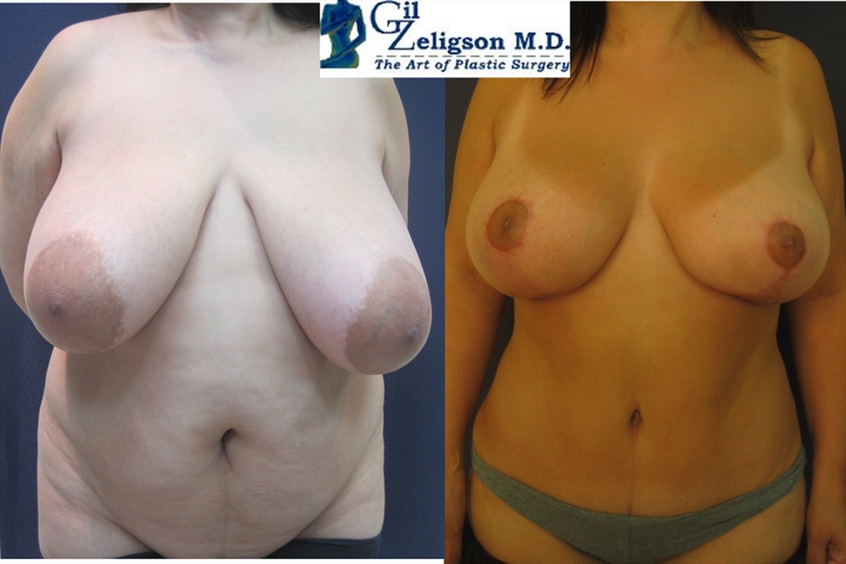 Dr. Gil Zeligson - Tummy Tuck Abdomino plasty
