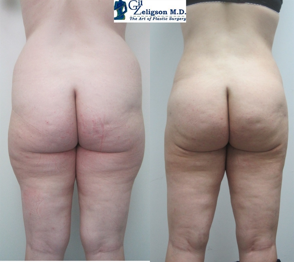 Dr. Gil Zeligson - Liposuction