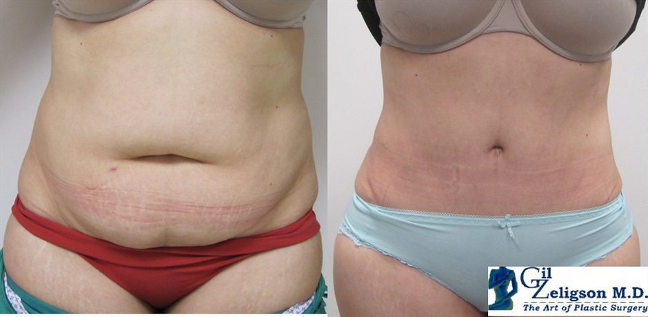 Dr. Gil Zeligson - Tummy Tuck Abdomino plasty