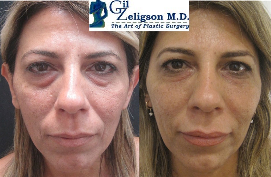 Dr. Gil Zeligson - Facial Sculpturing Hyaluronic acid