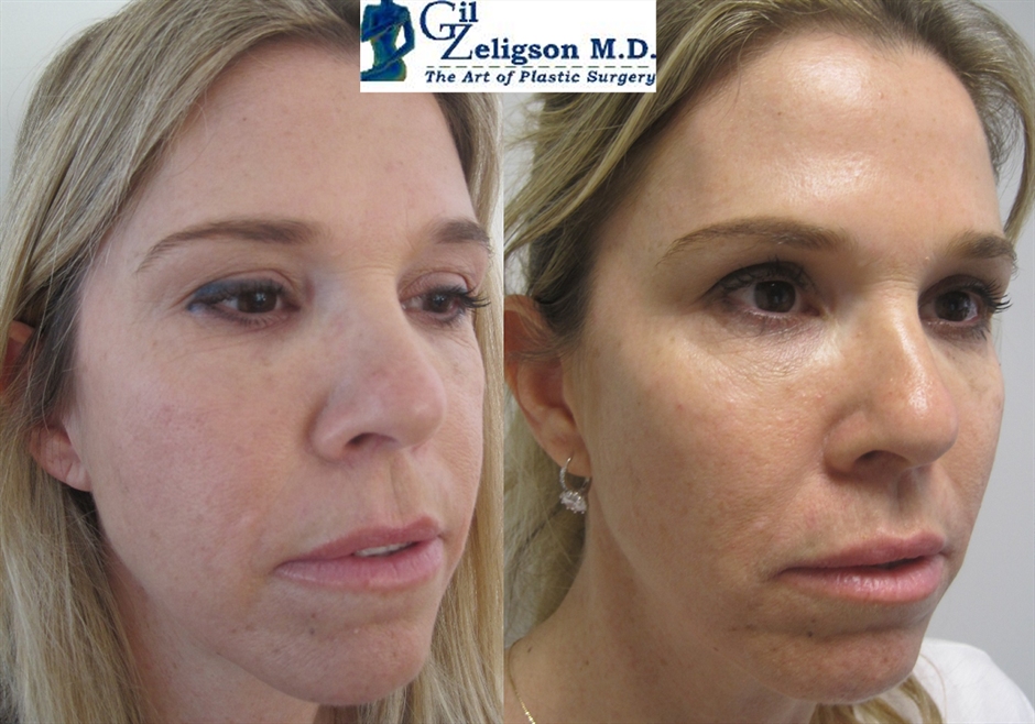 Dr. Gil Zeligson - Facial Sculpturing Hyaluronic acid