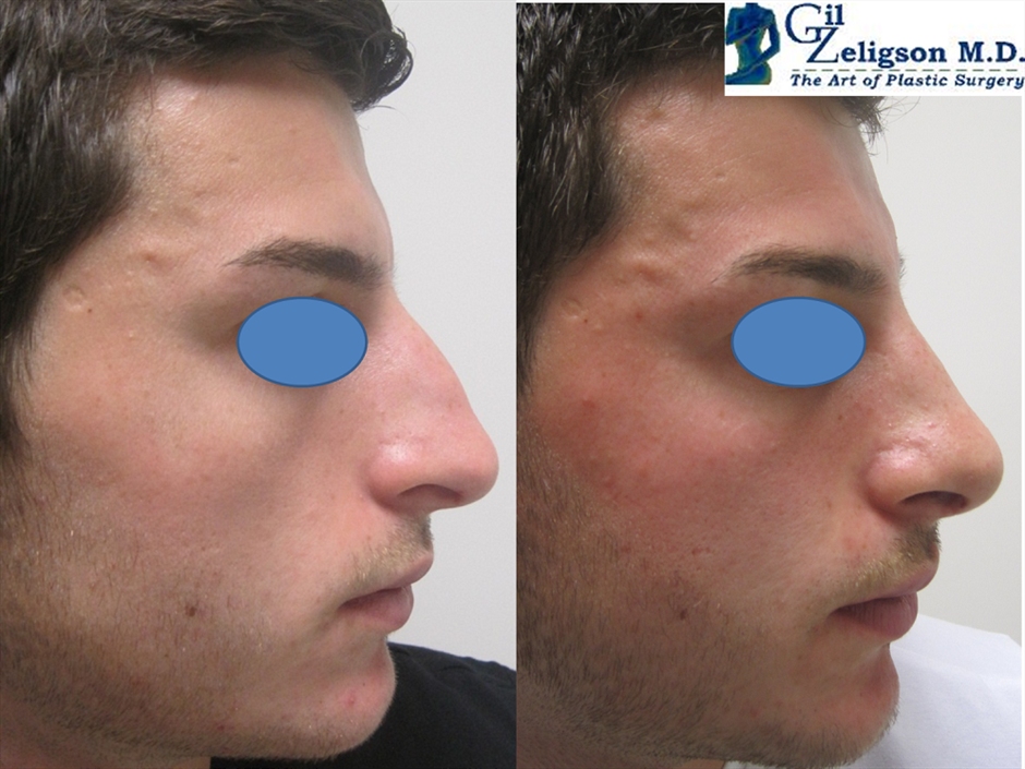 Dr. Gil Zeligson - Rhinoplasty