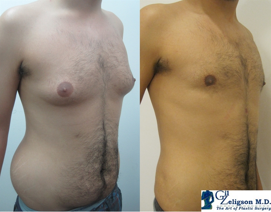 Dr. Gil Zeligson - Liposuction