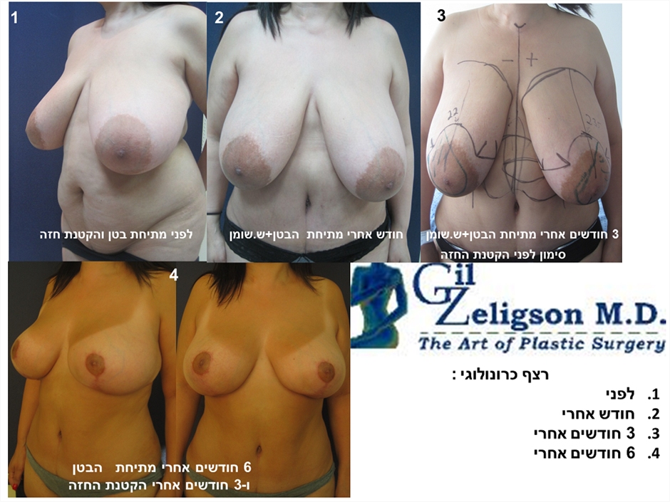 Dr. Gil Zeligson - Tummy Tuck Abdomino plasty
