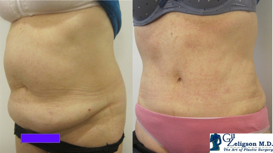 Dr. Gil Zeligson - Tummy Tuck Abdomino plasty