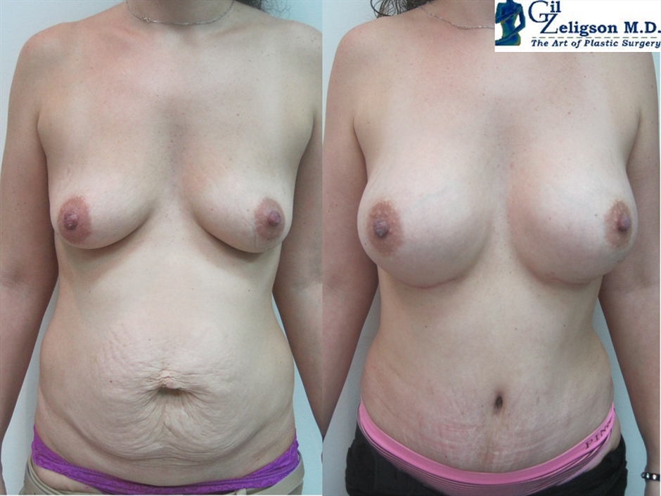Dr. Gil Zeligson - Tummy Tuck Abdomino plasty